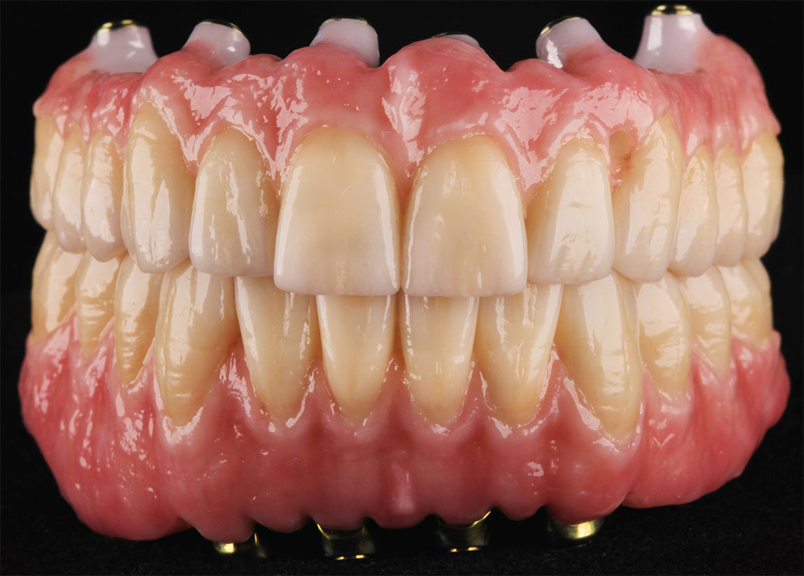 Model of implant dentures