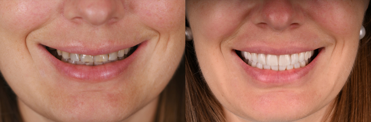 Boston dental patient smiling before and after treatment