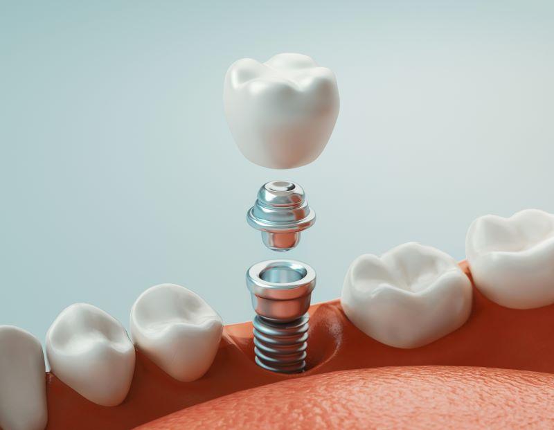 Dental implant, abutment, and crown between natural teeth