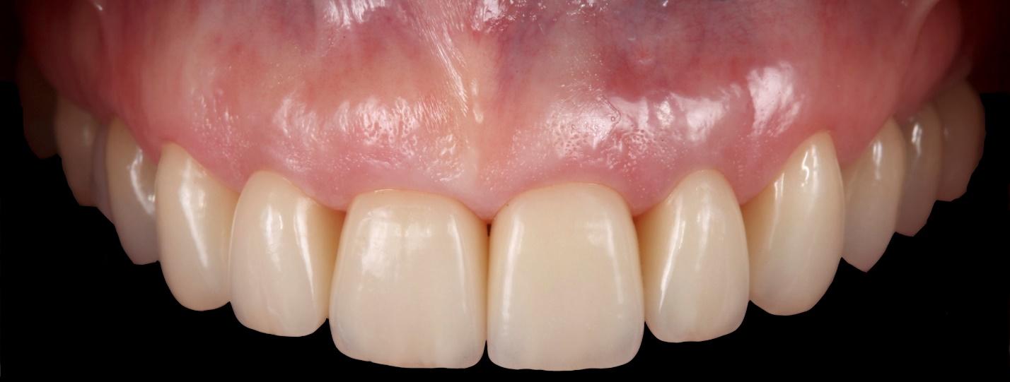 Close-up photo of patient’s upper dental arch after dental implant restoration