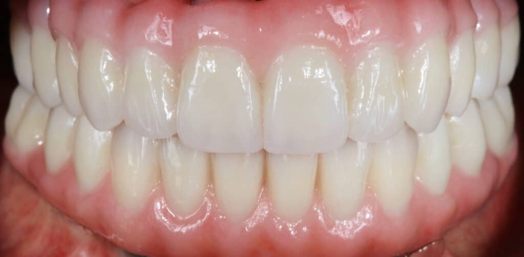 Am I a Candidate for Implant Dentures in Boston? - The Face Dental Group